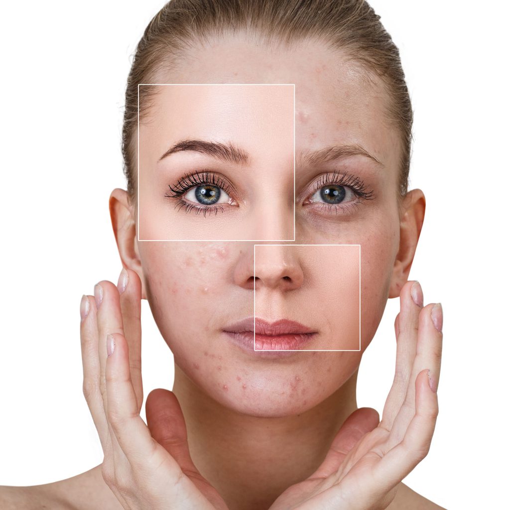 Acne Treatment Birmingham 90 Success Improve Your Skin