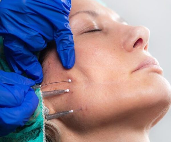 meso-threads-face-lifting-treatment-mesotherapy-aesthetic-medicine_798657-18680